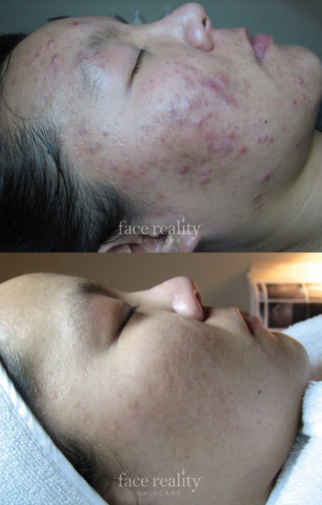 Before and after image of face reality acne treatment